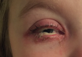 Ligneous Conjunctivitis